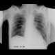 Pericardial effusion after myocardial biopsy, before: X-ray - Plain radiograph